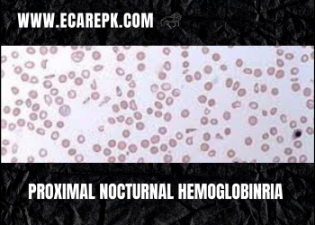 Knowledge About Paroxysmal Nocturnal Hemoglobinuria Fully Explained Cause and Treatments