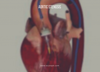 Understanding Aortic Stenosis and Normal Indications of Aortic Stenosis Include // Chest Torment
