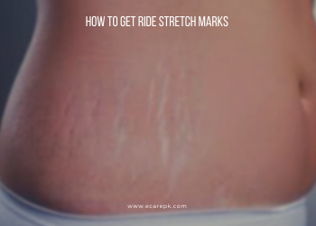 What to Know About Stretch Marks and Pregnancy is the Most Widely Recognized Reason for Stretch Imprints.